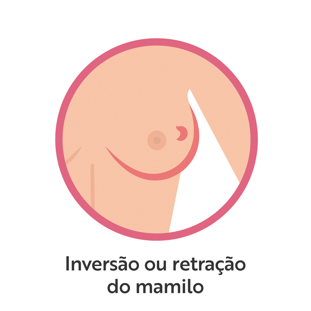 Inversão ou retração do mamilo